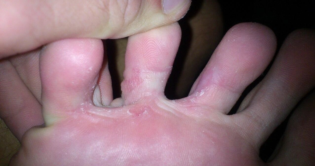 Champignon parmi les doigts des pieds au traitement de la crème Demyxil