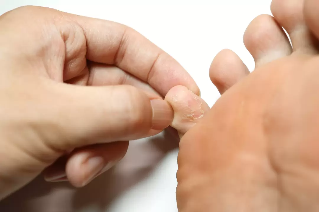 Champignon sur les doigts et son traitement avec la crème Demyxil avec crème