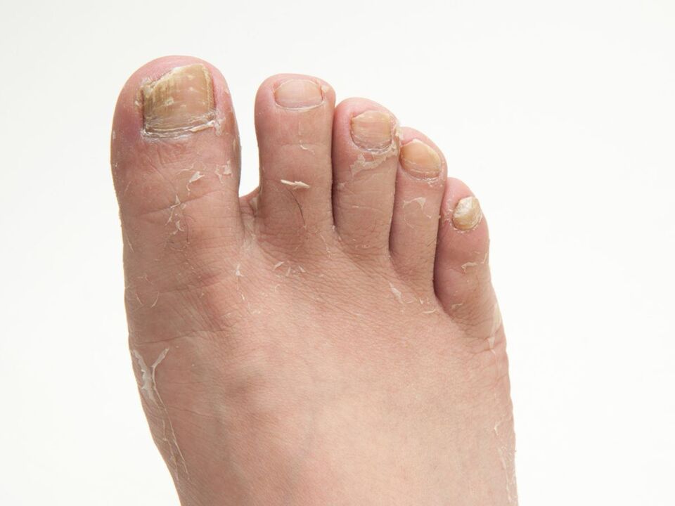 champignon sur la peau des jambes et son traitement avec la crème ZXCVBNMQWORT