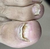 Lancement du champignon de l'ongle