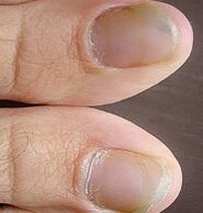 Signes cliniques
