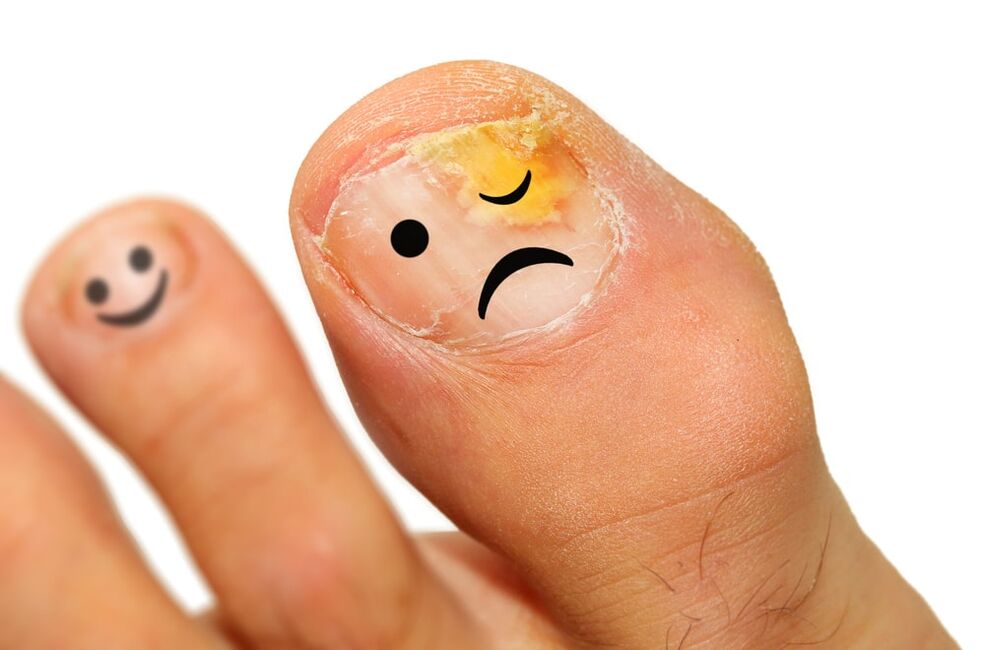 champignon dans l'ongle