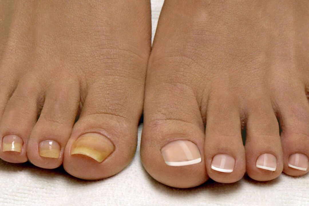 Dans une jambe de ongle saine, de l'autre avec un champignon