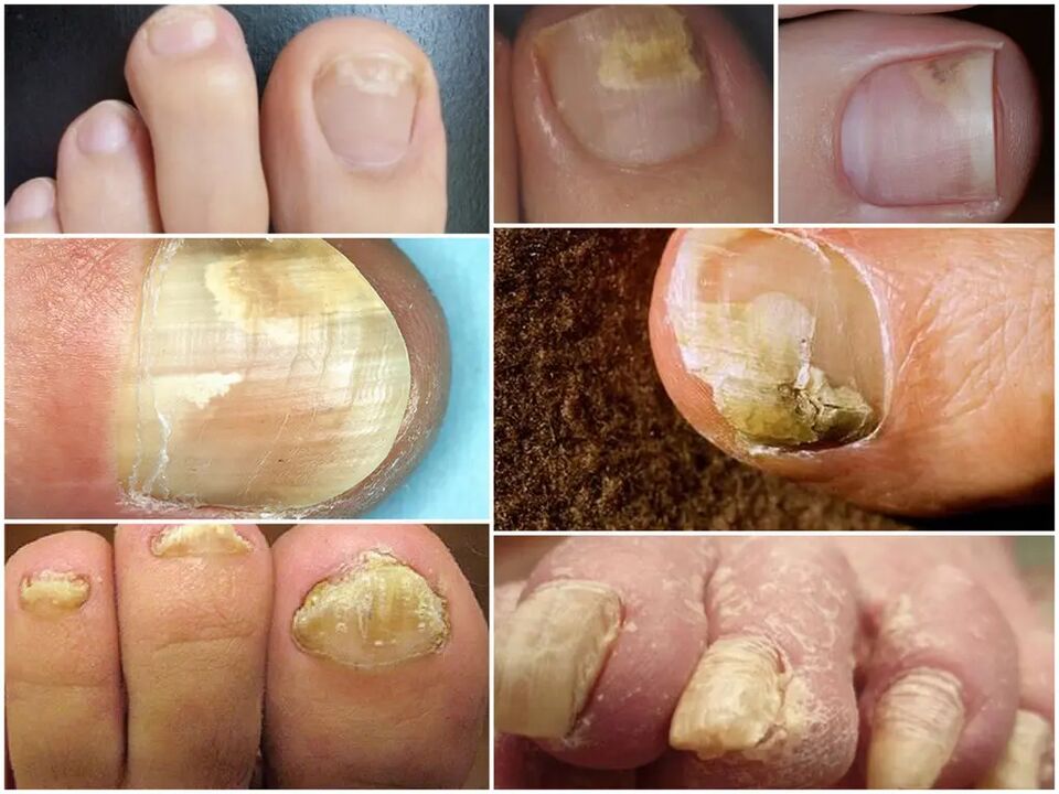 Stades de développement du champignon des ongles des pieds.