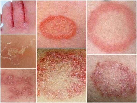 Trichophytose de la peau des jambes.